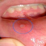 How to Identify and Treat Oral Infections Early?