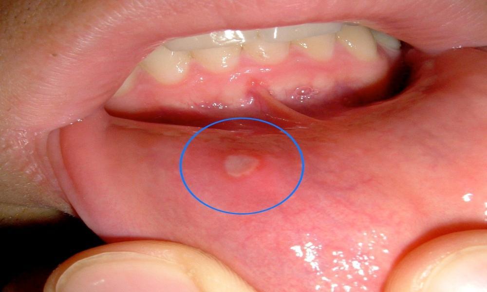 Oral Infections